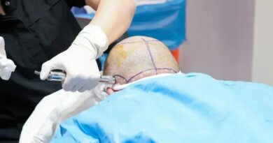 Tragédia em clínica na Turquia: britânico morre durante transplante capilar