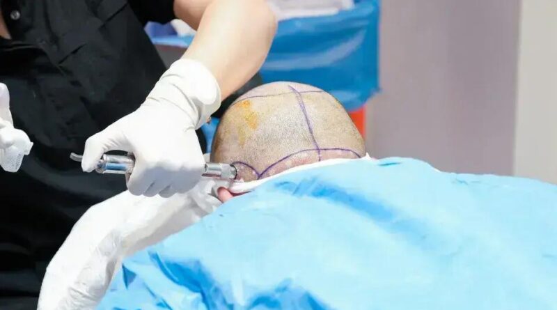 Tragédia em clínica na Turquia: britânico morre durante transplante capilar