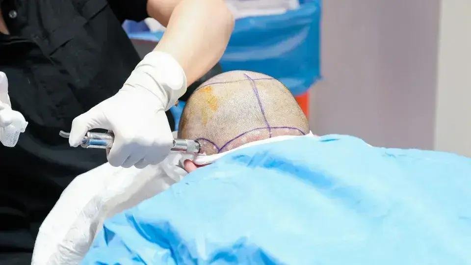Tragédia em clínica na Turquia: britânico morre durante transplante capilar