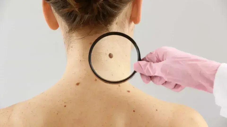 Regra ABCDE: Como identificar sinais de câncer de pele facilmente