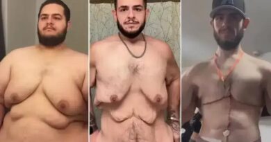 Influencer Garrett Olson perde 150 kg e realiza cirurgia de retirada de pele