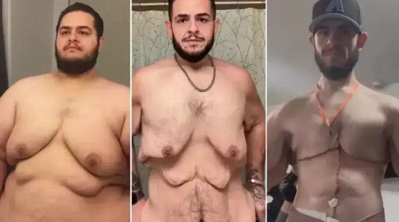 Influencer Garrett Olson perde 150 kg e realiza cirurgia de retirada de pele