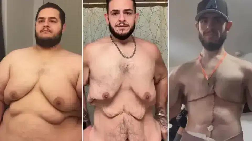Influencer Garrett Olson perde 150 kg e realiza cirurgia de retirada de pele