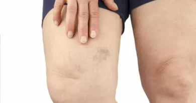 Descubra Mitos e Verdades Sobre as Varizes e Seus Sintomas