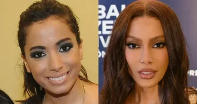 Antes e depois das cirurgias plásticas: Transformações de celebridades