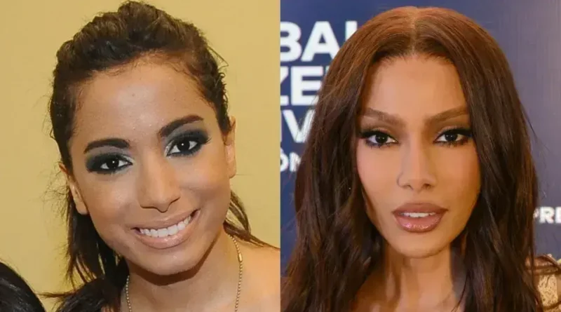 Antes e depois das cirurgias plásticas: Transformações de celebridades