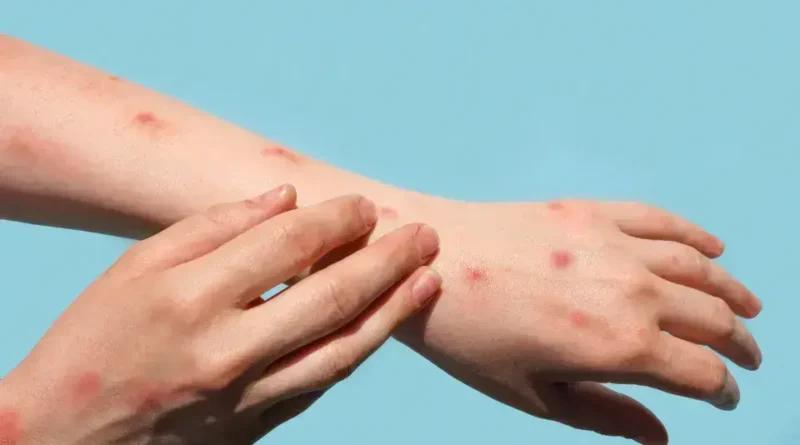 Brasil registra 48 casos de mpox em início de 2026; São Paulo é o foco