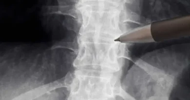 Neurologistas alertam sobre falta de evidências para uso da polilaminina