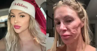 Brandi Glanville revela origem do parasita que afetou seu rosto