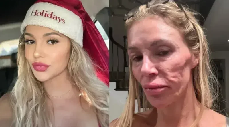 Brandi Glanville revela origem do parasita que afetou seu rosto