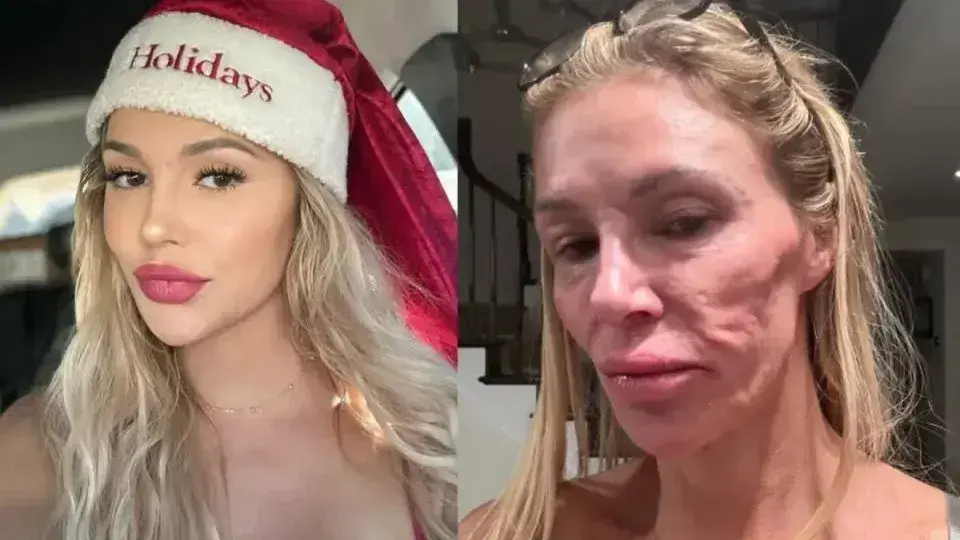 Brandi Glanville revela origem do parasita que afetou seu rosto