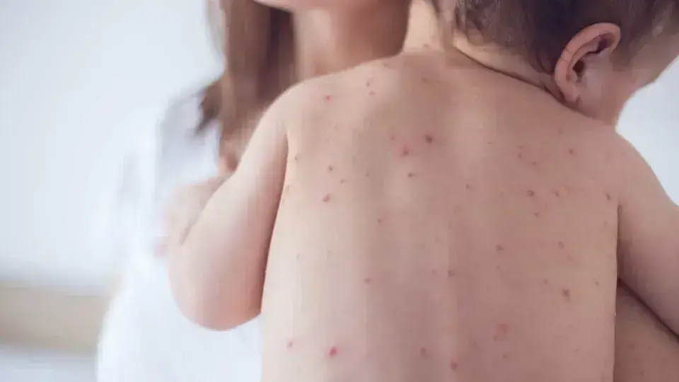 São Paulo registra aumento de casos de sarampo e recomendações de vacinação